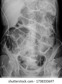 Posterior anterior abdominal x-ray showing signs of intestinal obstruction with massive distension of intestines and a nasogastric tube placed in stomache