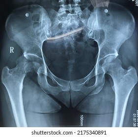 Posterior Dislocation Of Rt Hip
