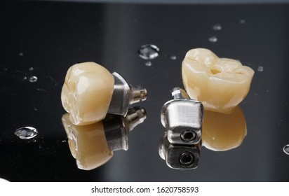 Posterior implant crown with custom abutment - Shutterstock ID 1620758593