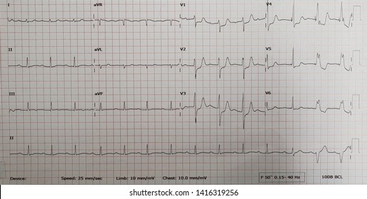 Posterior Wall STEMI With 1st Degree AV Block. Total Occlusion Distal RCA.