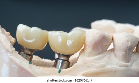 posterior zirconia implant crown with custom abutment - Shutterstock ID 1620766147