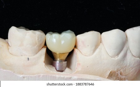 Posterior Zirconia Implant Crown With Screw Hole