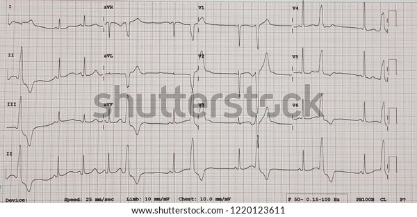 Posteroseptal Rvot Pvc Sinus Rhythm Positive Stock Photo Edit Now