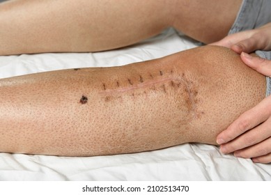 Postoperative suture on woman's leg. Closeup of scar after knee fracture. Traces of interrupted sutures leg after surgery. Recovery and wound healing concept