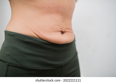 Postpartum problems. Skin after diet. Ugly belly. Complications. The course of pregnancy. Women's question. Stretched skin on the abdomen after losing weight, sagging abdomen, loose abdomina skin