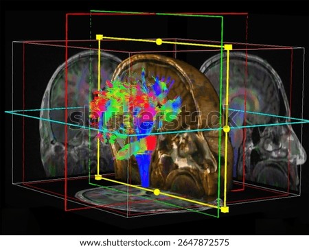 Post-processed 3D MRI image showing a brain tumor with associated fiber tract disruption using DTI (Diffusion Tensor Imaging). loss of white matter fibers near the lesion.
