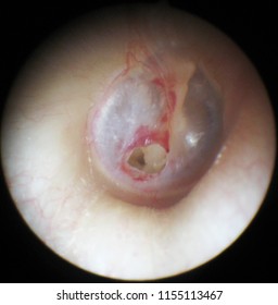 Posttraumatic Perforation Of The Tympanic Membrane