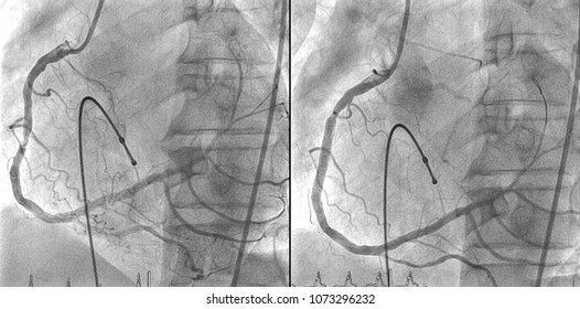 Pre And Post Percutaneous Coronary Intervention At Right Coronary Artery, Support With Temporary Cardiac Pacemaker During Procedure In Cardiac Catheterization Laboratory Room.