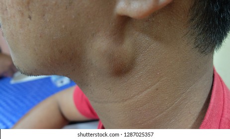 Preauricular Swelling With Differential Diagnosis Of Parotid Swelling Or Lymphadenopathy.