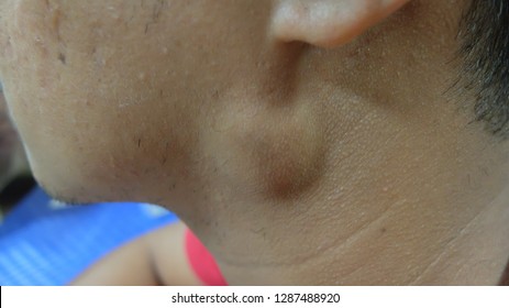 swollen parotid lymph node