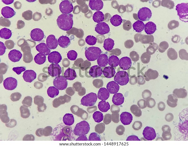 Precursor Bcell All Peripheral Blood Smear Stock Photo Edit Now 
