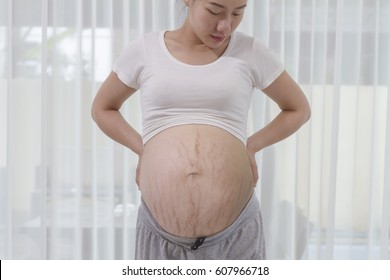 Pregnancy belly stretch mark concept, young asian woman hands hold stretch mark belly