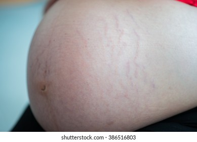 Pregnancy belly stretch marks skin close up 