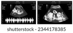 pregnancy ultrasound film genecology sonogram, baby medical ultra scan diagnostic control