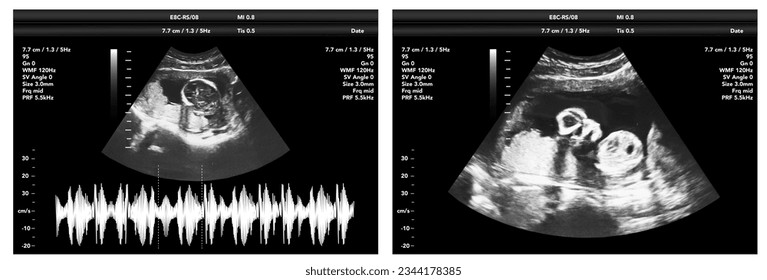 pregnancy ultrasound film genecology sonogram, baby medical ultra scan diagnostic control - Powered by Shutterstock