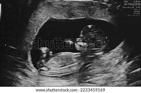 Pregnant baby infant ultrasound display. Mother or mom belly screen in hospital. Womb technology scan.