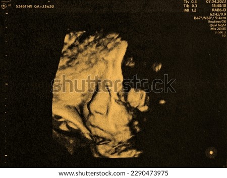 Pregnant baby infant ultrasound display. Mother belly screen in hospital. Womb scan