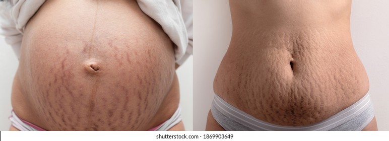 pregnant belly and belly with stretch marks after pregnancy - Shutterstock ID 1869903649