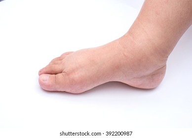 Pregnant Women Edema Of Foot