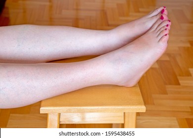 Pregnant Women With Swelling Feet, Foot Swelling During Pregnancy. Swollen Feet.