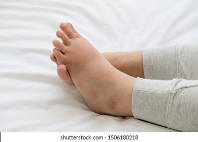 Pregnant Women With Swelling Feet, Pain Foot And Lying On Bed In The Room. Swollen Feet And Fetal Poisoning Or Toxicity Concept