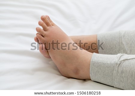 Pregnant women with swelling feet, pain foot and lying on bed in the room. Swollen feet and fetal poisoning or toxicity concept
