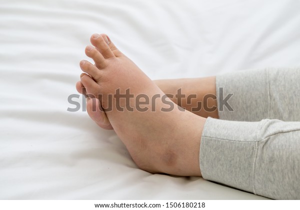 Pregnant women with swelling feet, pain foot and\
lying on bed in the room. Swollen feet and fetal poisoning or\
toxicity concept