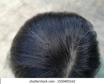 Premature Gray Hair Asian People Are Caused By Stress.
