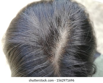 Premature Gray Hair Asian People Are Caused By Stress.
