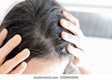 Premature gray hair problem,stressed asian young woman with hair loss,thyroid or autoimmune disorders,alopecia areata,deficiency of vitamins,concerned about graying hair,health care,medical concept