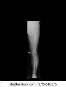 Preoperative Anterior-posterior X-ray Of A Left Leg Showing Mild Varus Deformity And Osteoarthritis Of The Knee