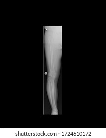 Preoperative Anterior-posterior X-ray Of A Right Leg Showing Mild Varus Deformity And Osteoarthritis Of The Knee