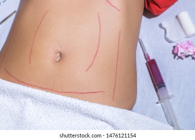 Preparation For Mesotherapy Treatment On Woman's Body