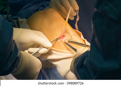 Preparation Tendon For ACLR (Arthroscopic ACL Reconstruction)