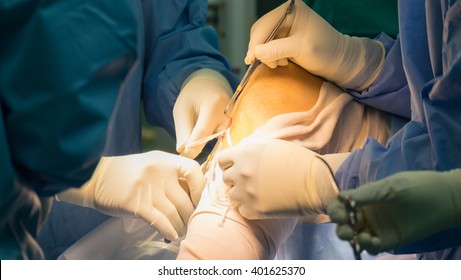Preparation tendon For ACLR (Arthroscopic ACL reconstruction)