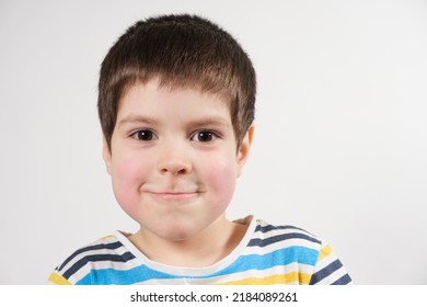 A Preschool Child Of 4 Years Old With Red Cheeks Looks Into The Camera, Face Close-up. Diathesis In Children Or Redness Of The Cheeks After Cold And Frost