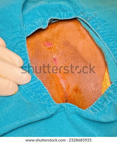 present  of pilonidal sinus tract cyst and abscess formation 