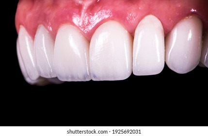 Press Ceramic Veneers B2 Color