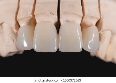 Press Ceramic Zirconia Dental Crowns
