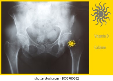 Prevention Of Osteoporosis And Hip Fracture Concept. X-ray Of Female Hip, Vitamin D, Calcium And  Sun Symbol On Yellow Background