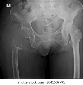 Primary Bone Tumor At Right  Femur  Xray