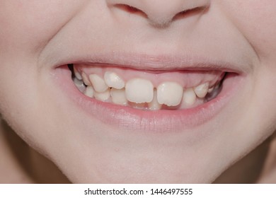 Childs Open Mouth Smiling Problem Caries Stock Photo (Edit Now) 1028347552
