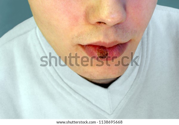 原発性梅毒 口唇の硬性下疳 の写真素材 今すぐ編集