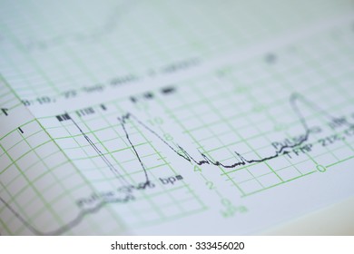 Printing Of Cardiogram Report Coming Out From Electrocardiograph In Labour Ward