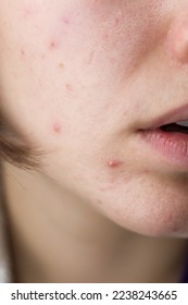 the problem of acne on the chin in a girl. acne. face with pimples. combined problem skin
 - Shutterstock ID 2238243665