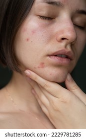 the problem of acne pimples on the chin. facial skin care. combination skin
 - Shutterstock ID 2229781285