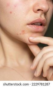 the problem of acne pimples on the chin. facial skin care. combination skin
 - Shutterstock ID 2229781287