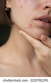 the problem of acne pimples on the chin. facial skin care. combination skin
				