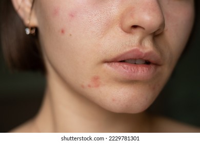 the problem of acne pimples on the chin. facial skin care. combination skin
 - Shutterstock ID 2229781301