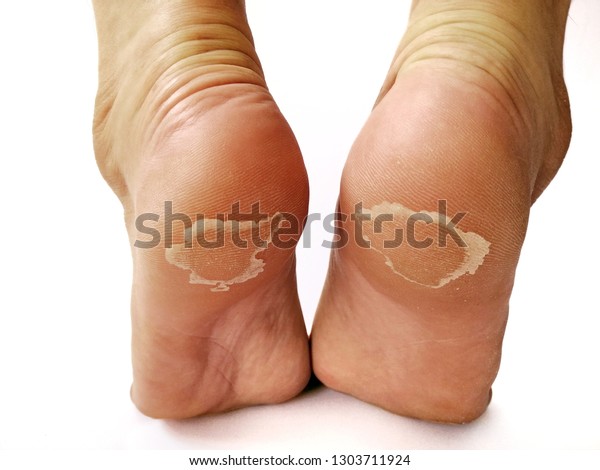 feet skin peeling remedy